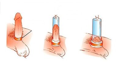 werkingsprincipe van een pomp voor penisvergroting